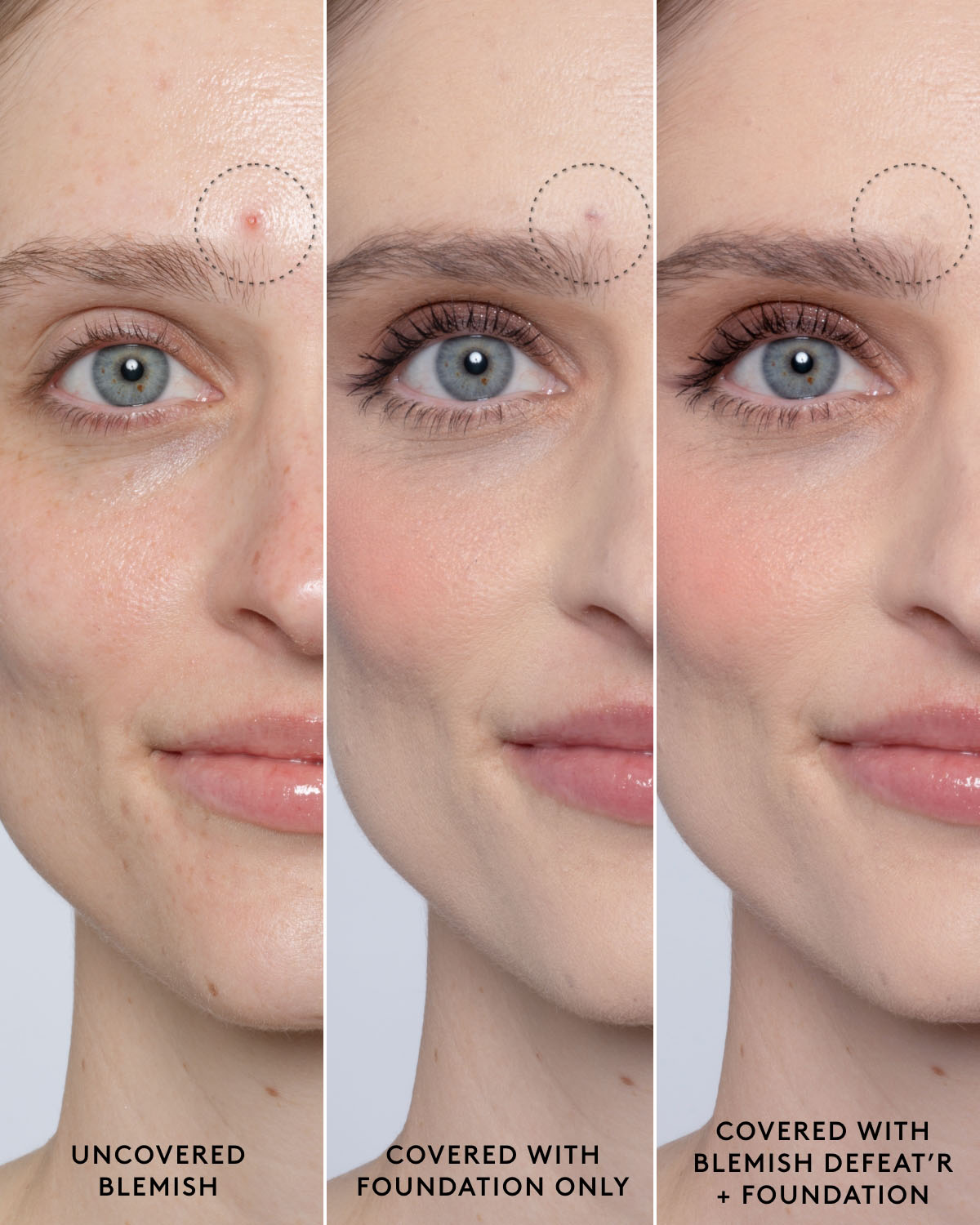 Close-up of model's light-toned face showing an uncovered blemish, a foundation-covered blemish and a foundation and Blemish Defeat'r BHA Spot-Targeting Gel-covered blemish.