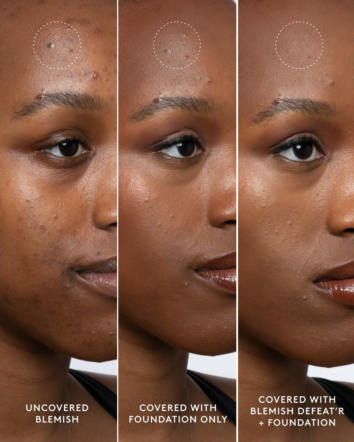 Close-up of model's deep-toned face showing an uncovered blemish, a foundation-covered blemish and a foundation and Blemish Defeat'r BHA Spot-Targeting Gel-covered blemish.