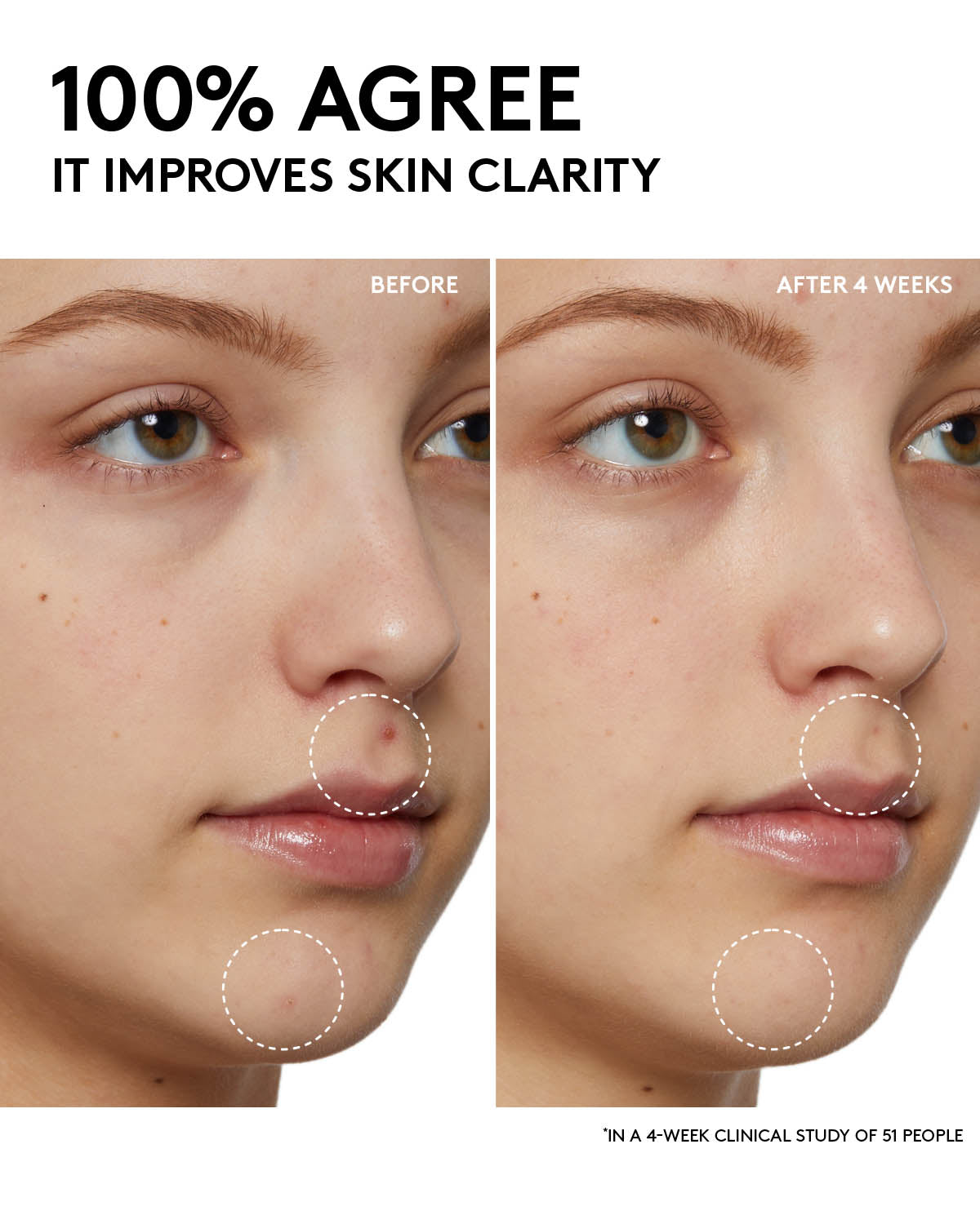 Before and after infographic picturing minimized blemishes. Copy reads 100% agree it improves skin clarity in a 4 week clinical study on 51 people.
